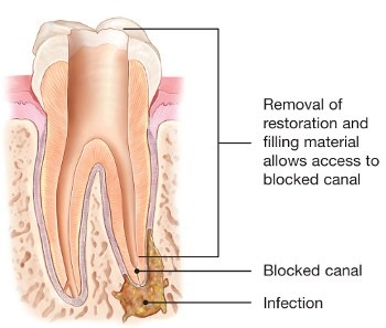 endodontic-retreatment-root-canals