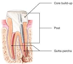 root-canal-post-300×262